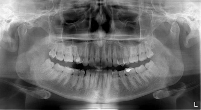 ортопантомограмма-зубов